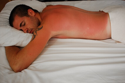 what to do if you can't sleep because of sunburn